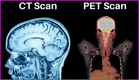 Can a PET scan detect squamous cell carcinoma?